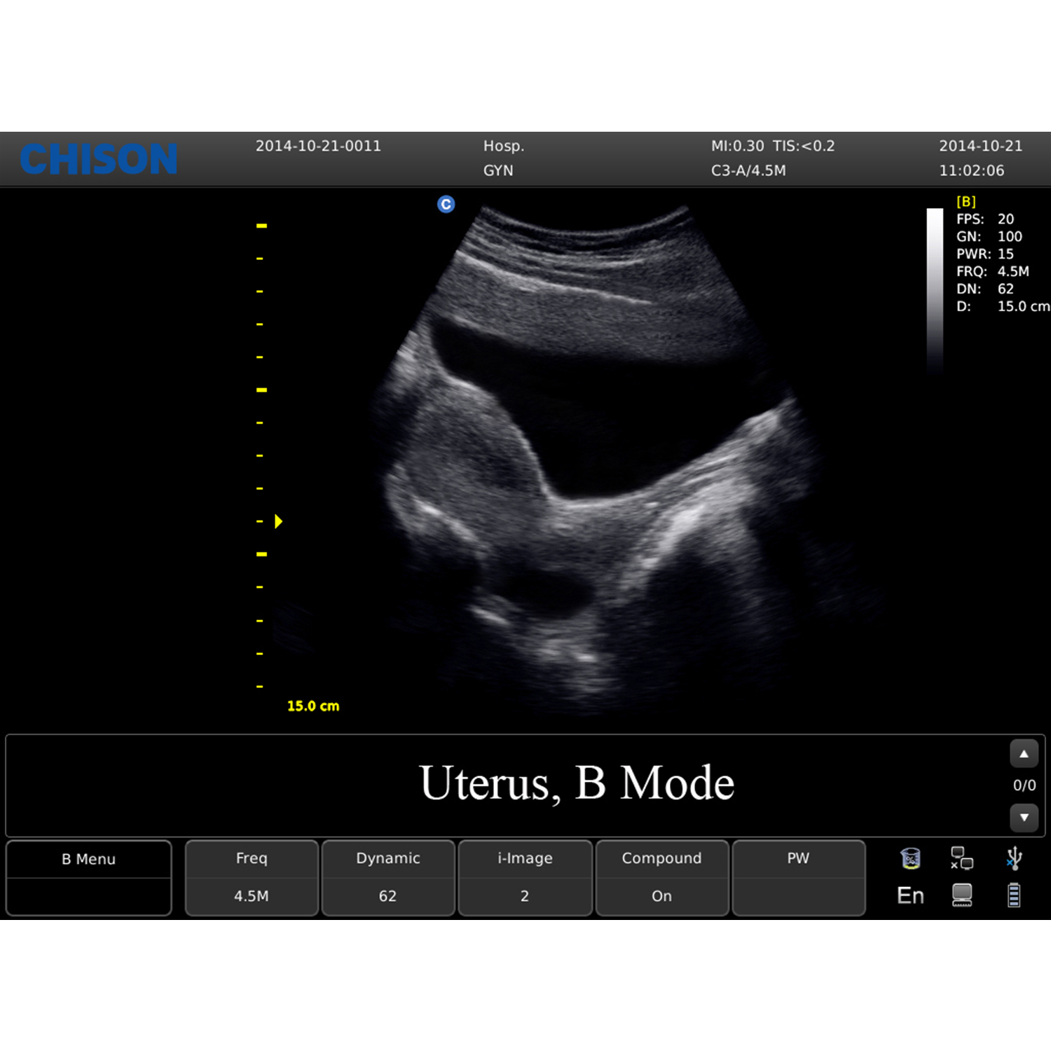 ECO 1 Utero BMode